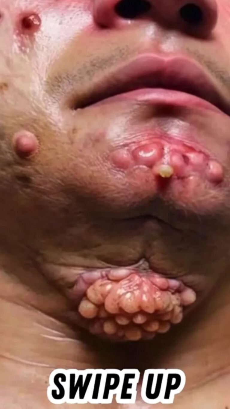 SEVEN THINGS THAT CLOG YOUR PORES AND CAUSE ACNE